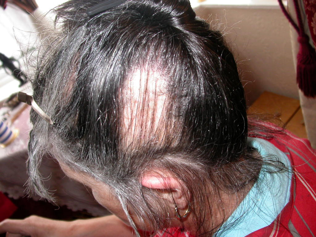 Silent Sufferers of Trichotillomania