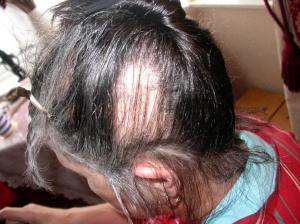 Silent Sufferers of Trichotillomania