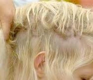 Nickle Clips can irritate the scalp