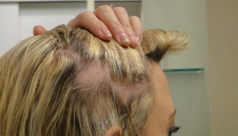 traction_alopecia_caused_by_hair_clipin_diane_shawe